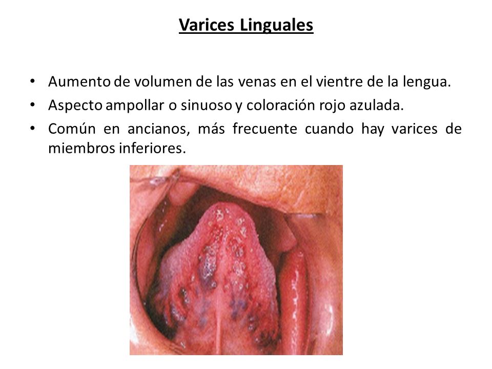 Varices Linguales Aumento de volumen de las venas en el vientre de la lengua. Aspecto ampollar o sinuoso y coloración rojo azulada.