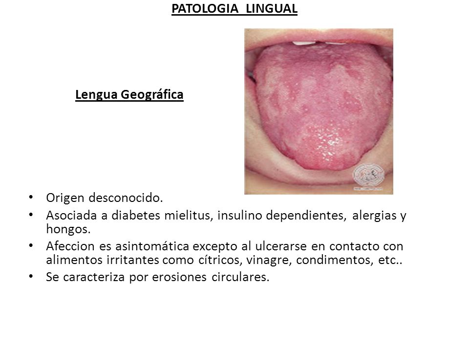 PATOLOGIA LINGUAL Lengua Geográfica. Origen desconocido. Asociada a diabetes mielitus, insulino dependientes, alergias y hongos.