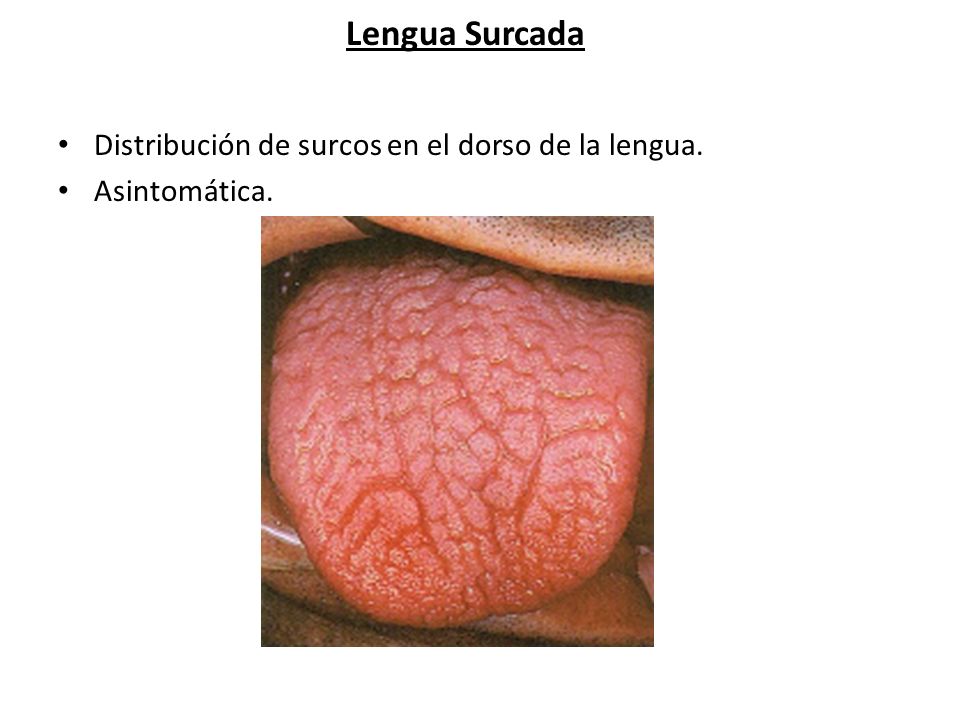 Lengua Surcada Distribución de surcos en el dorso de la lengua.