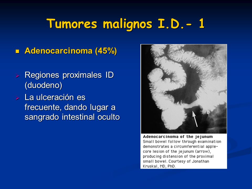 Tumores malignos I.D.- 1 Adenocarcinoma (45%)