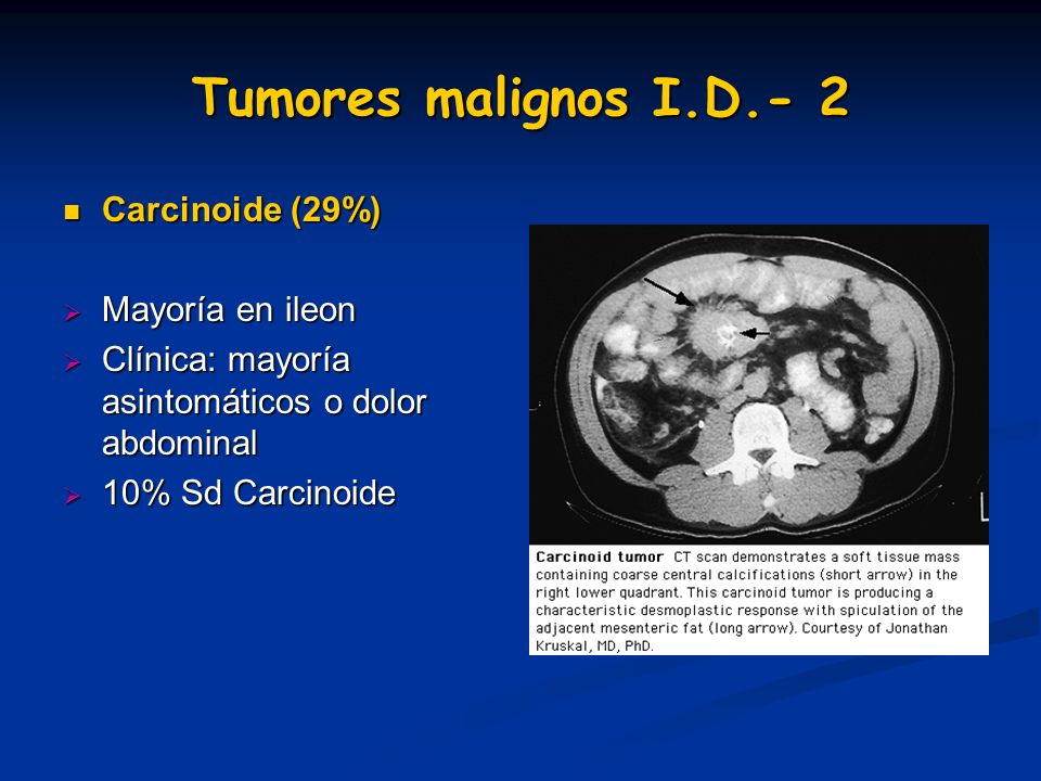 Tumores malignos I.D.- 2 Carcinoide (29%) Mayoría en ileon