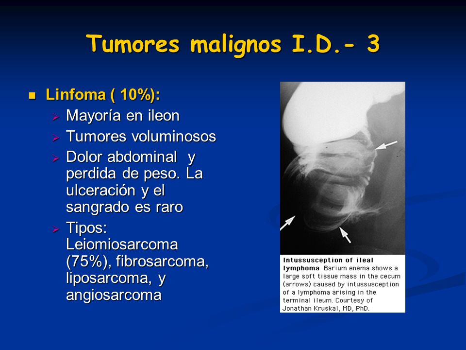 Tumores malignos I.D.- 3 Linfoma ( 10%): Mayoría en ileon