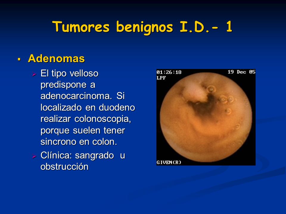 Tumores benignos I.D.- 1 Adenomas