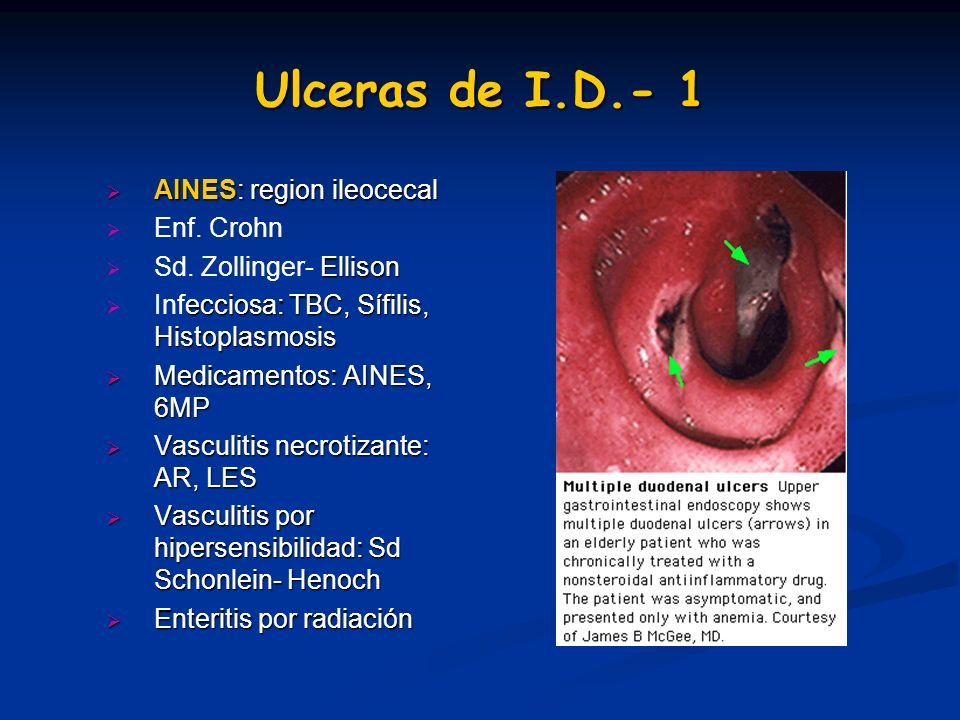 Ulceras de I.D.- 1 AINES: region ileocecal Enf. Crohn