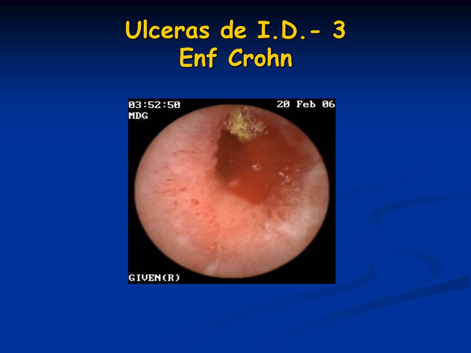 Ulceras de I.D.- 3 Enf Crohn