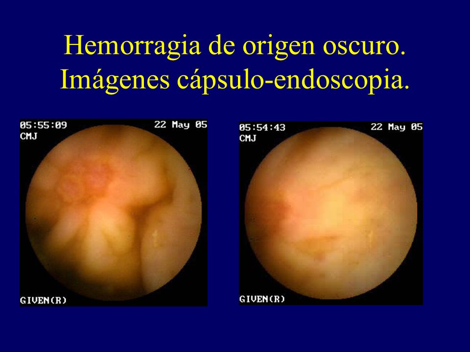 Hemorragia de origen oscuro. Imágenes cápsulo-endoscopia.