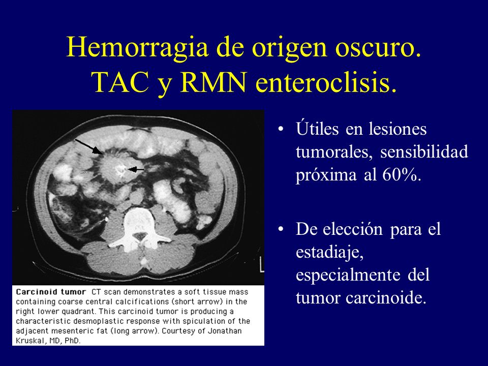 Hemorragia de origen oscuro. TAC y RMN enteroclisis.