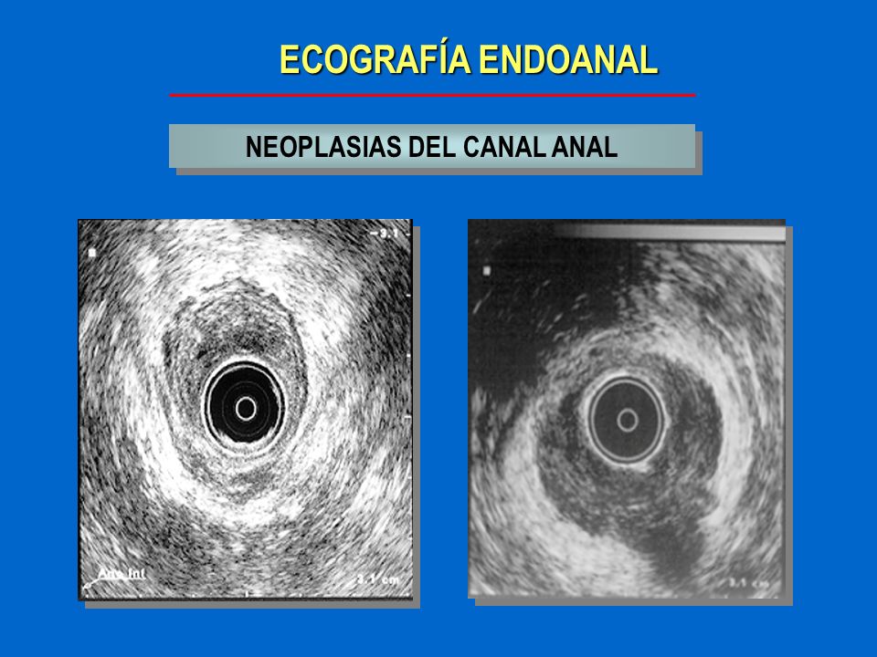 NEOPLASIAS DEL CANAL ANAL