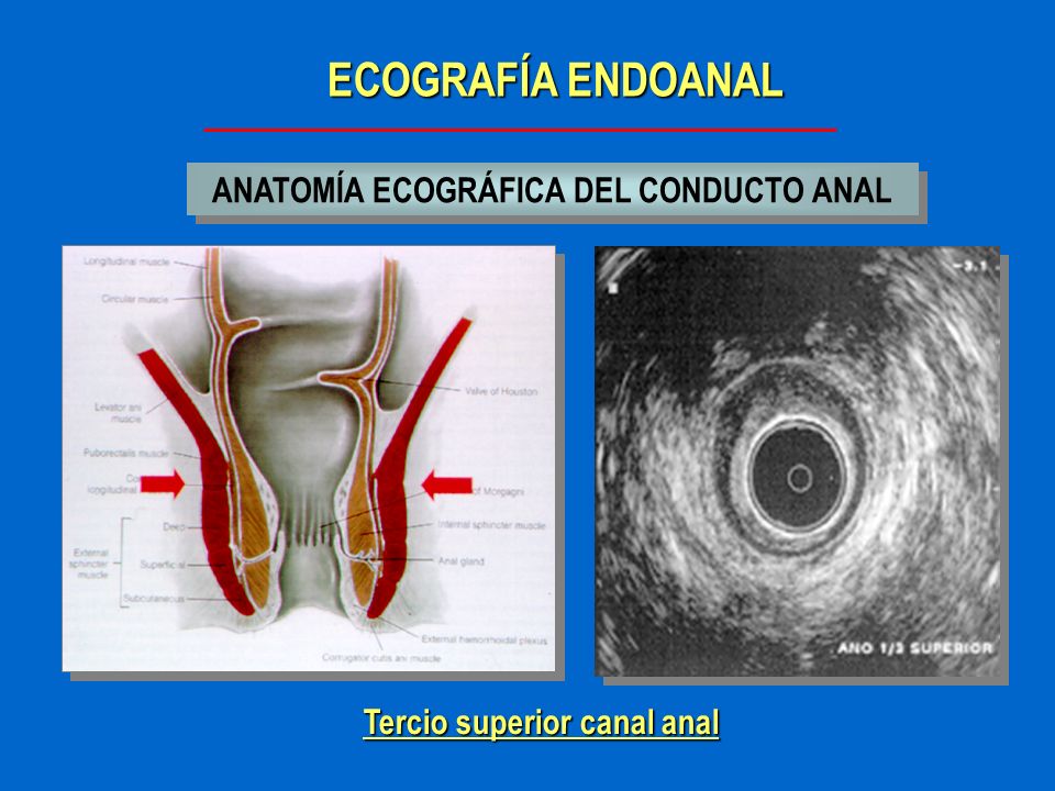 ANATOMÍA ECOGRÁFICA DEL CONDUCTO ANAL Tercio superior canal anal