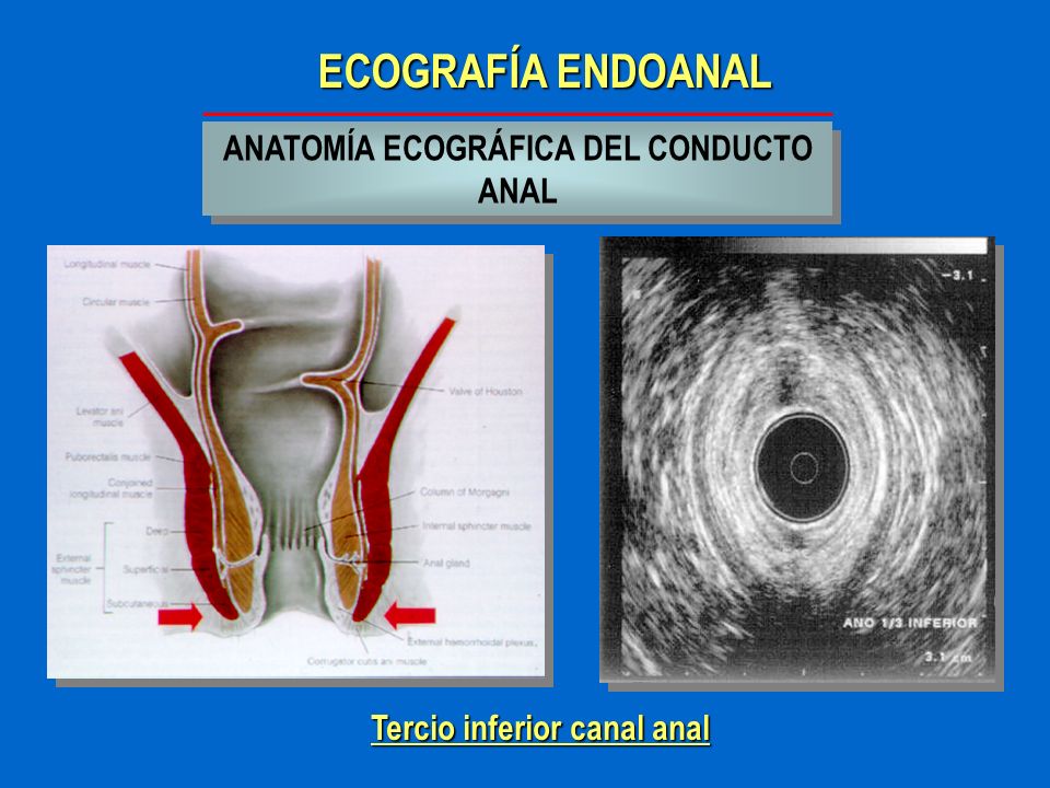 ANATOMÍA ECOGRÁFICA DEL CONDUCTO ANAL Tercio inferior canal anal