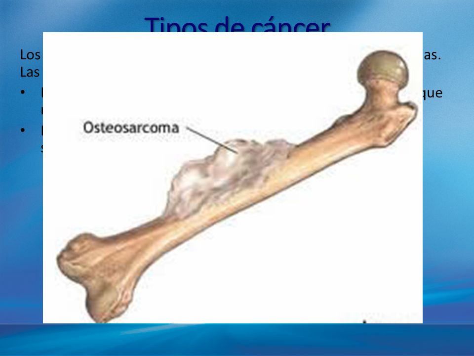 Tipos de cáncer Los tipos de cáncer se pueden agrupar en categorías más amplias. Las categorías principales de cáncer son: