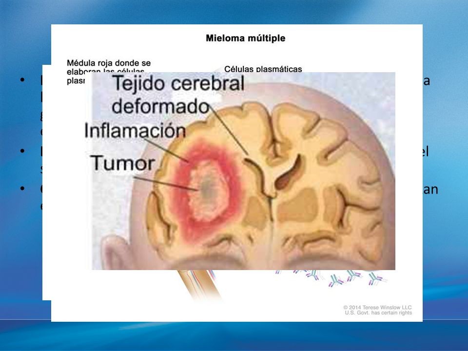 Leucemia: cáncer que empieza en el tejido en el que se forma la sangre, como la médula ósea, y causa que se produzcan grandes cantidades de células sanguíneas anormales y que entren en la sangre.