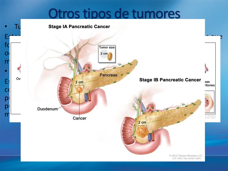 Otros tipos de tumores Tumores de células germinativas