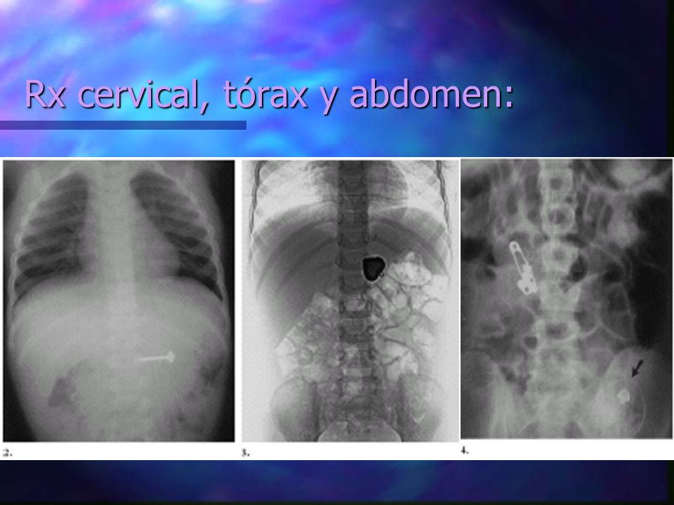 Rx cervical, tórax y abdomen: