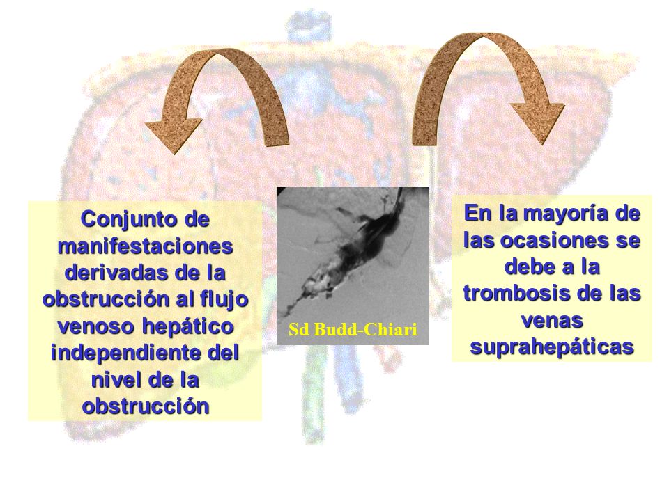 En la mayoría de las ocasiones se debe a la trombosis de las venas suprahepáticas