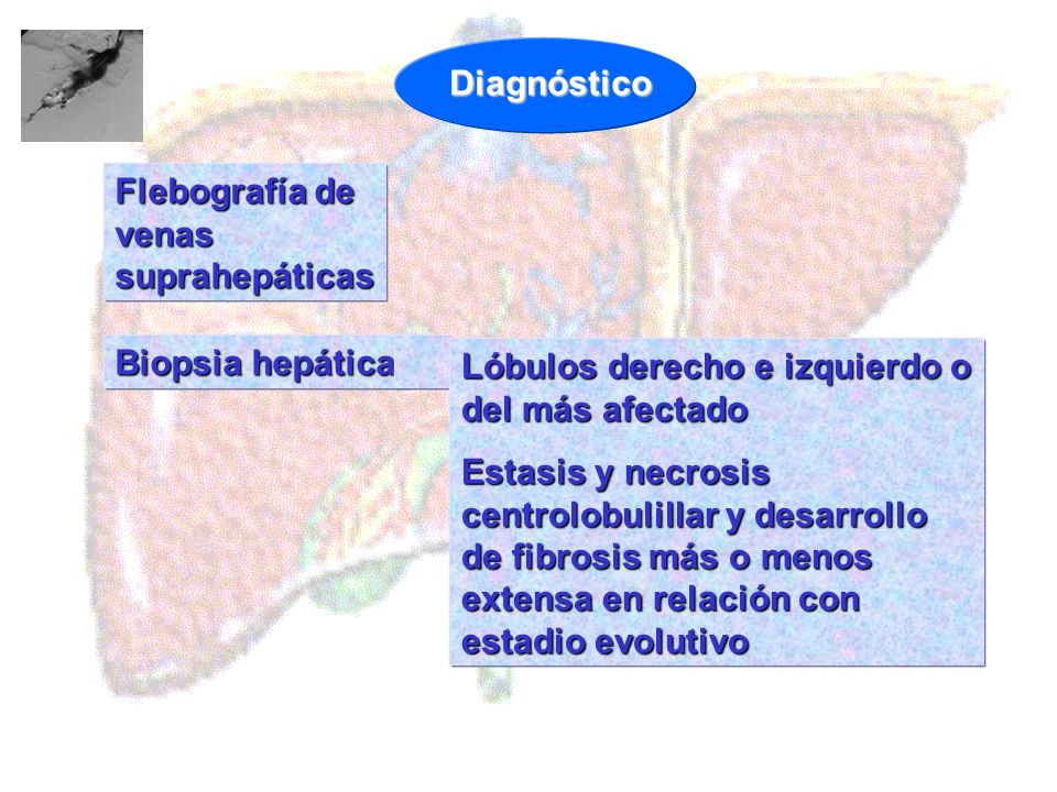 Diagnóstico Flebografía de venas suprahepáticas. Biopsia hepática. Lóbulos derecho e izquierdo o del más afectado.