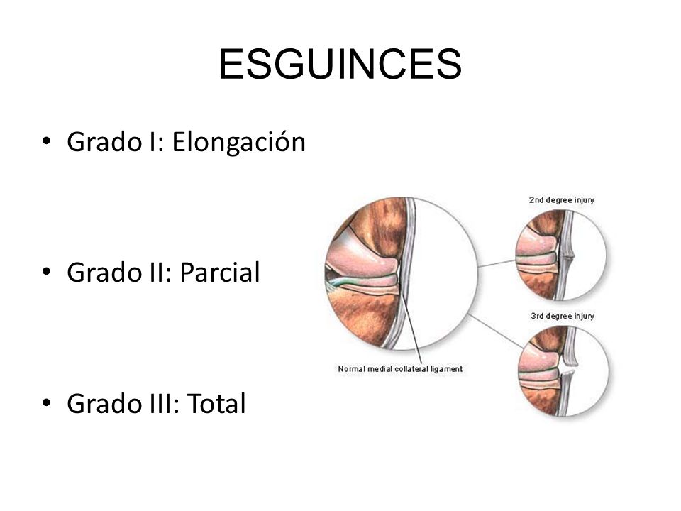 ESGUINCES Grado I: Elongación Grado II: Parcial Grado III: Total