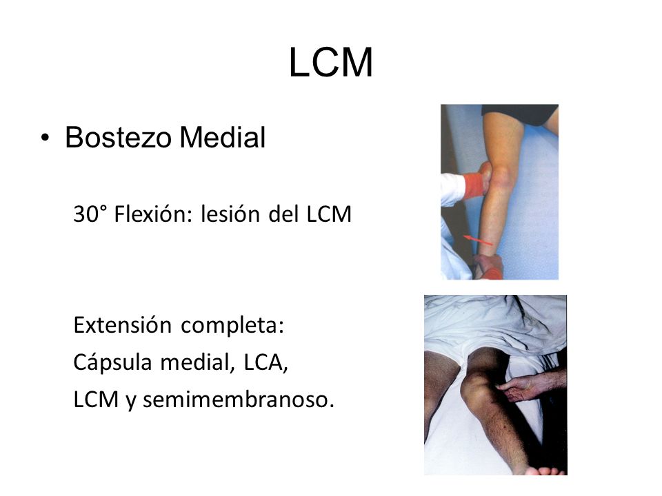 LCM Bostezo Medial 30° Flexión: lesión del LCM Extensión completa: