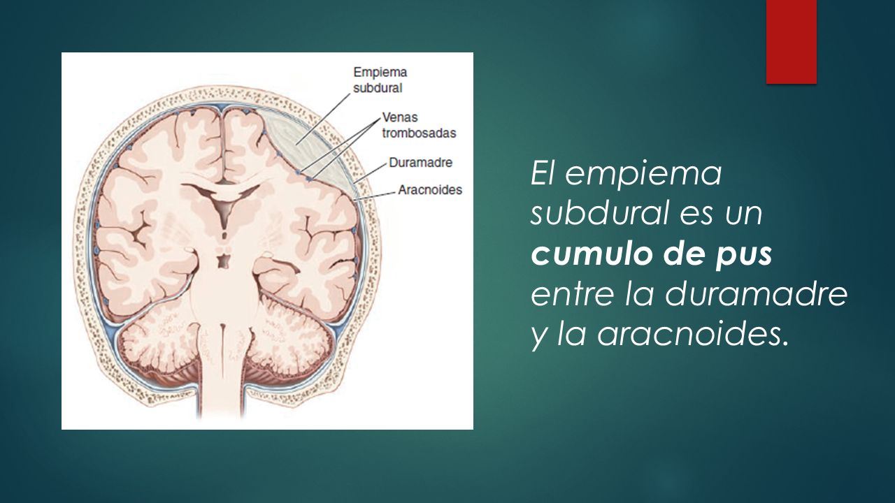 El empiema subdural es un cumulo de pus entre la duramadre y la aracnoides.
