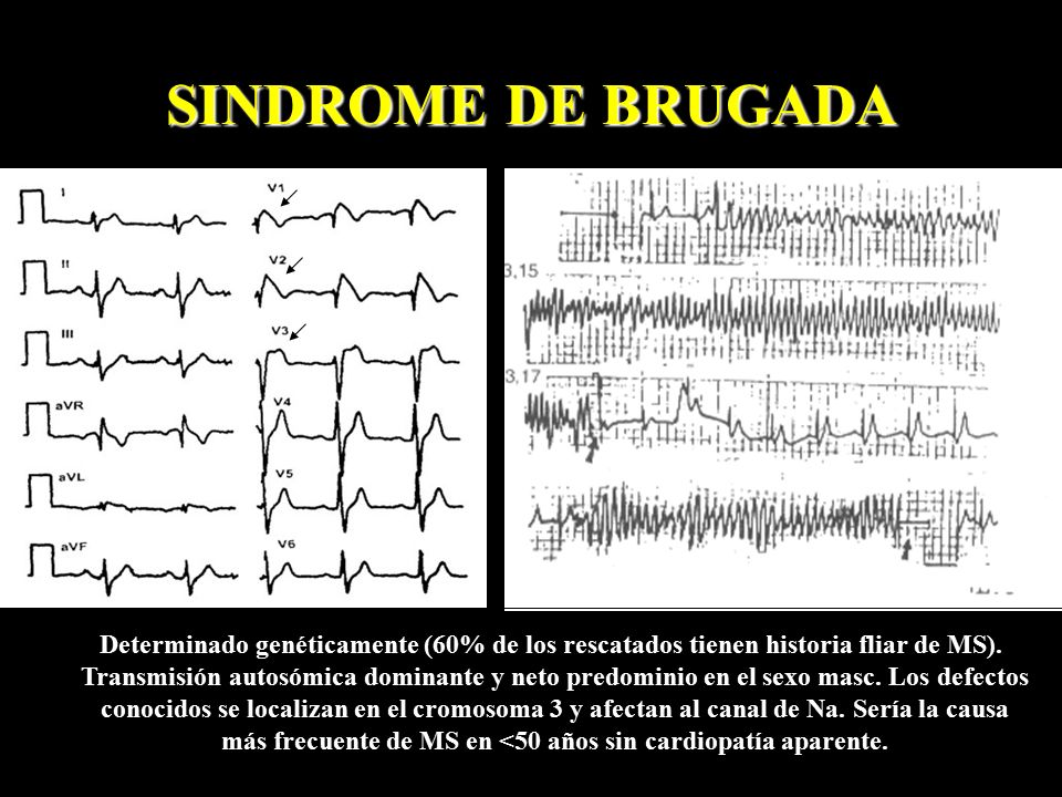 más frecuente de MS en <50 años sin cardiopatía aparente.