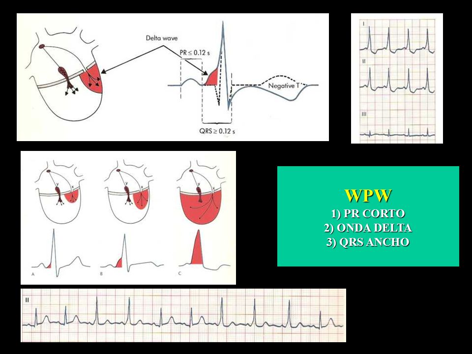 WPW 1) PR CORTO 2) ONDA DELTA 3) QRS ANCHO