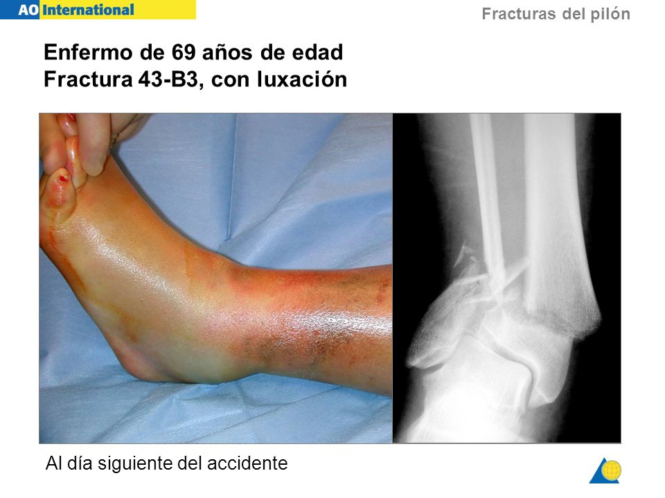 Enfermo de 69 años de edad Fractura 43-B3, con luxación