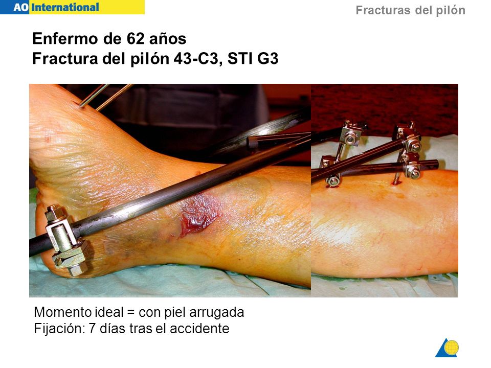 Enfermo de 62 años Fractura del pilón 43-C3, STI G3