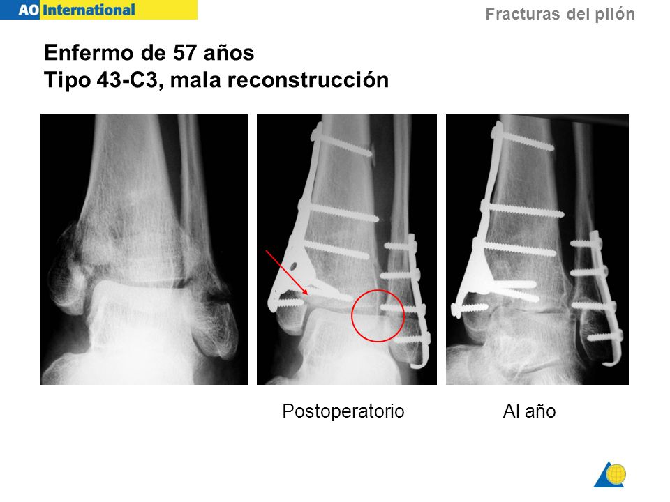 Enfermo de 57 años Tipo 43-C3, mala reconstrucción