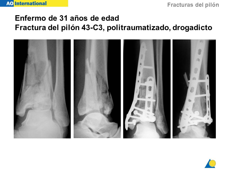 Enfermo de 31 años de edad Fractura del pilón 43-C3, politraumatizado, drogadicto