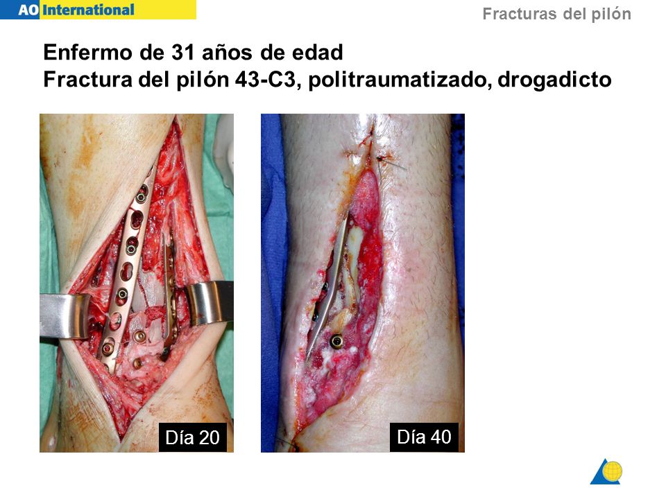 Enfermo de 31 años de edad Fractura del pilón 43-C3, politraumatizado, drogadicto