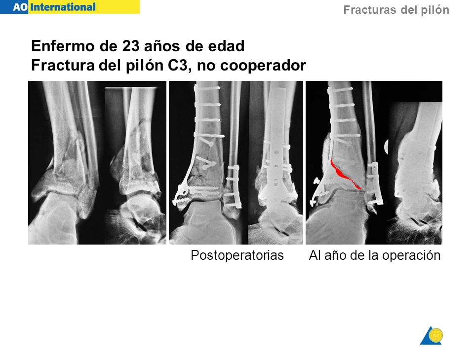 Enfermo de 23 años de edad Fractura del pilón C3, no cooperador