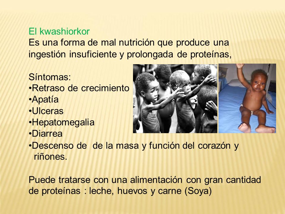El kwashiorkor Es una forma de mal nutrición que produce una. ingestión insuficiente y prolongada.