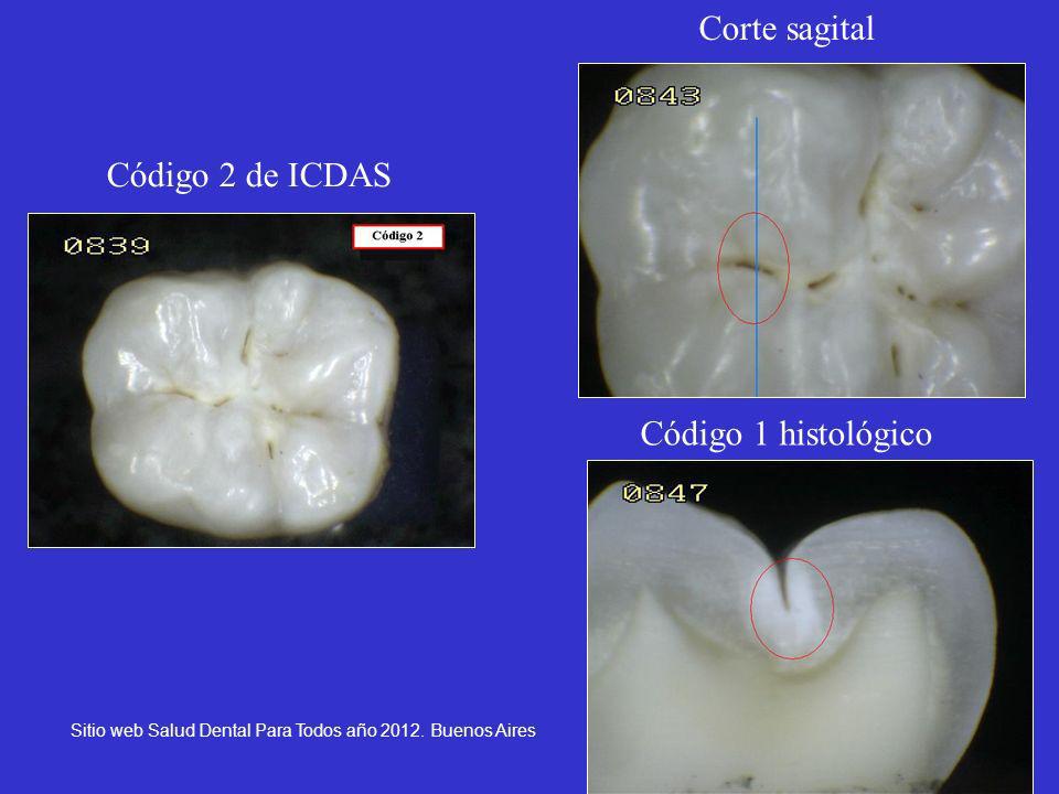 Corte sagital Código 2 de ICDAS Código 1 histológico