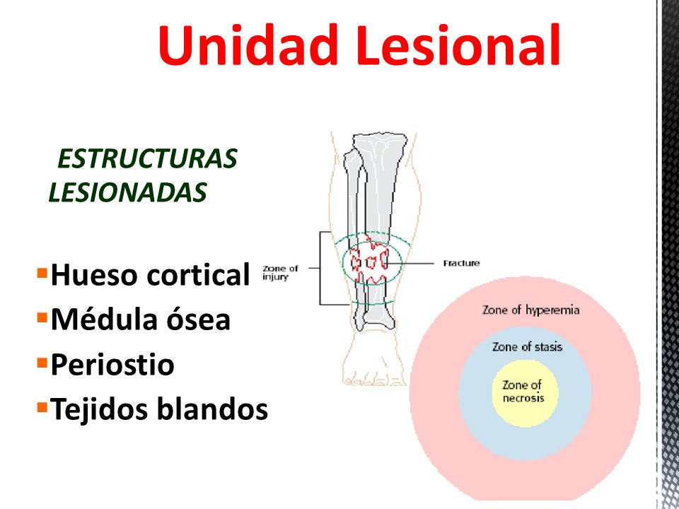 Unidad Lesional ESTRUCTURAS LESIONADAS Hueso cortical Médula ósea