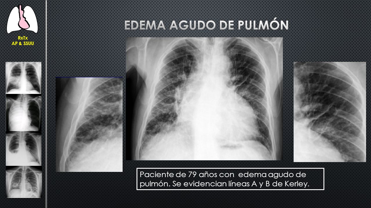 RxTx AP & SSUU. Edema agudo de pulmón. Paciente de 79 años con edema agudo de pulmón.