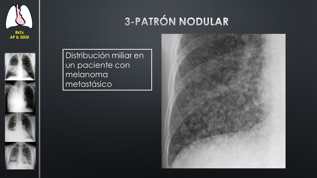 RxTx AP & SSUU 3-Patrón nodular Distribución miliar en un paciente con melanoma metastásico