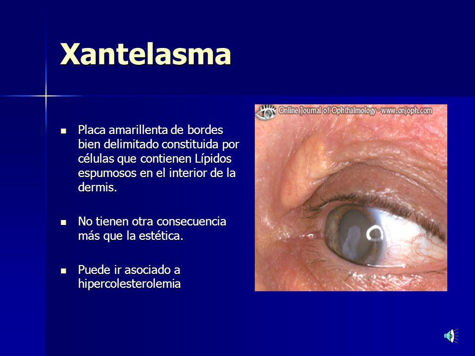Xantelasma Placa amarillenta de bordes bien delimitado constituida por células que contienen Lípidos espumosos en el interior de la dermis.