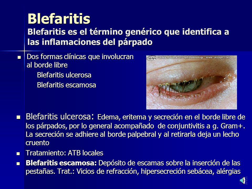 Blefaritis Blefaritis es el término genérico que identifica a las inflamaciones del párpado