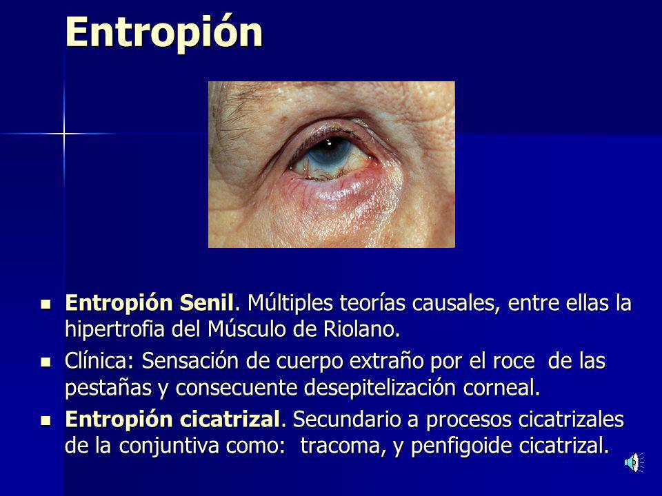 Entropión Entropión Senil. Múltiples teorías causales, entre ellas la hipertrofia del Músculo de Riolano.