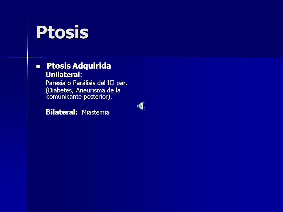 Ptosis Ptosis Adquirida Unilateral: Paresia o Parálisis del III par.