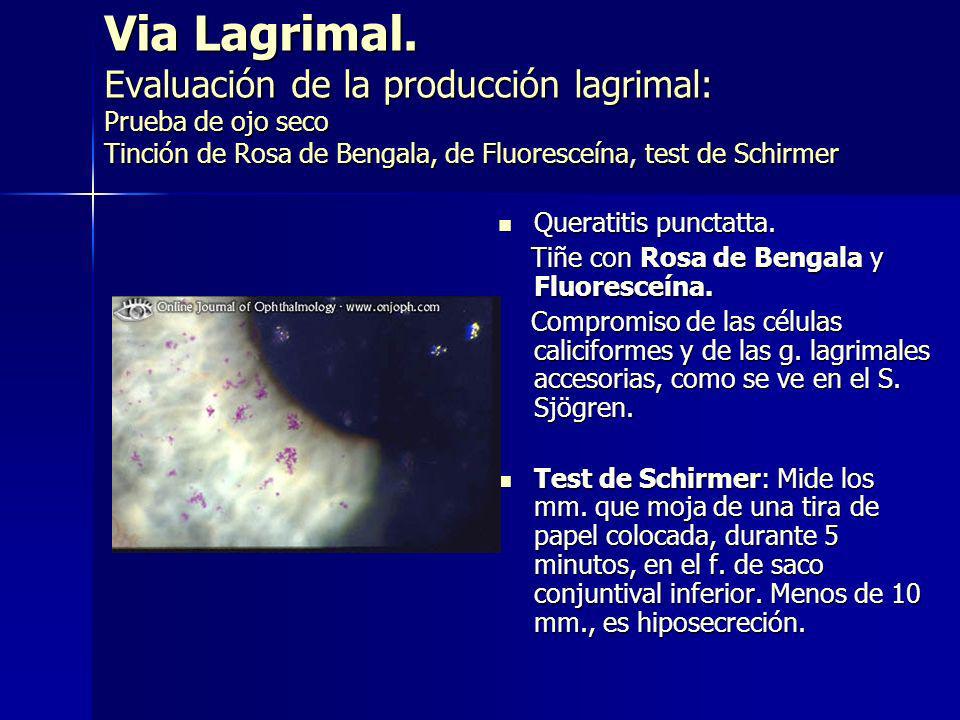 Via Lagrimal. Evaluación de la producción lagrimal: Prueba de ojo seco Tinción de Rosa de Bengala, de Fluoresceína, test de Schirmer