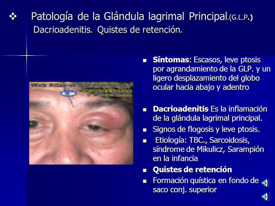 Patología de la Glándula lagrimal Principal.(G.L.P.) Dacrioadenitis. Quistes de retención.
