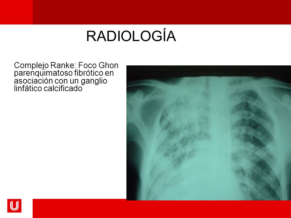 RADIOLOGÍA Complejo Ranke: Foco Ghon parenquimatoso fibrótico en asociación con un ganglio linfático calcificado.