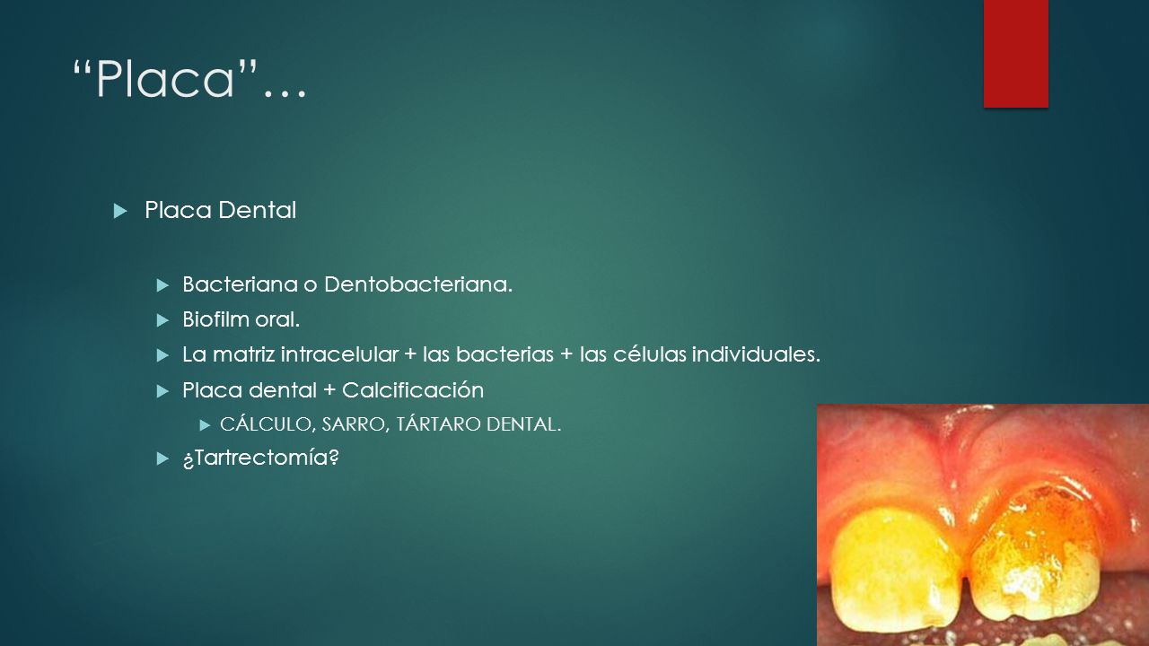 Placa … Placa Dental Bacteriana o Dentobacteriana. Biofilm oral.