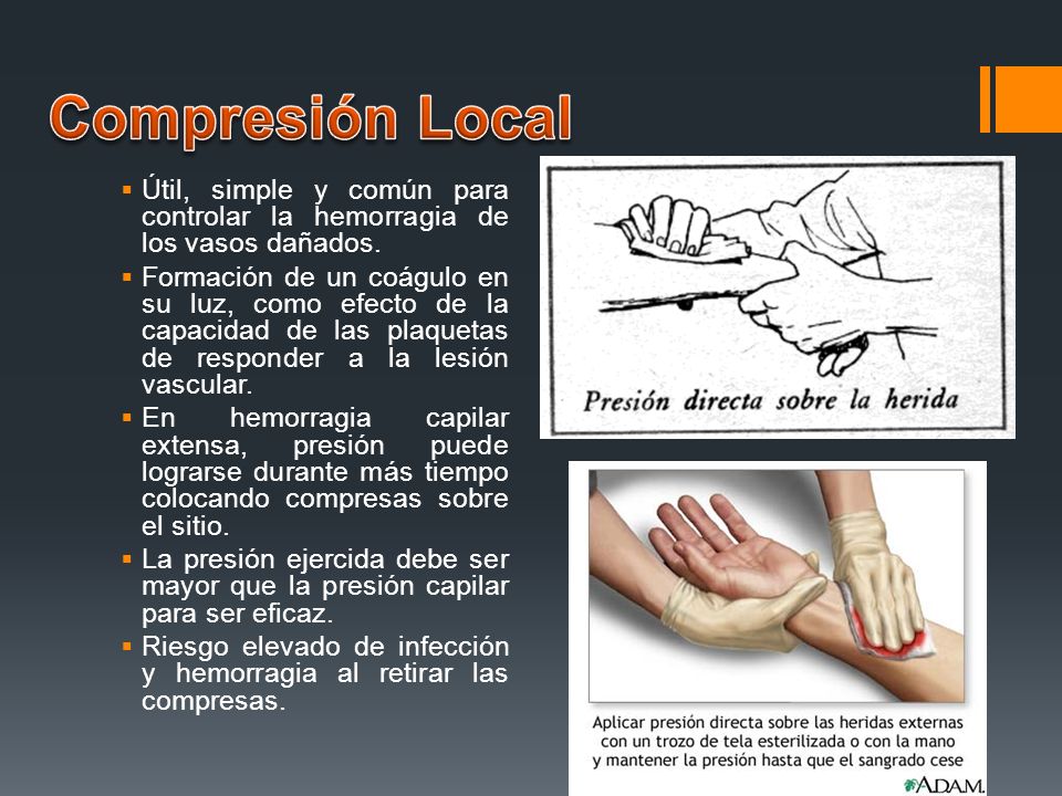 Compresión Local Útil, simple y común para controlar la hemorragia de los vasos dañados.