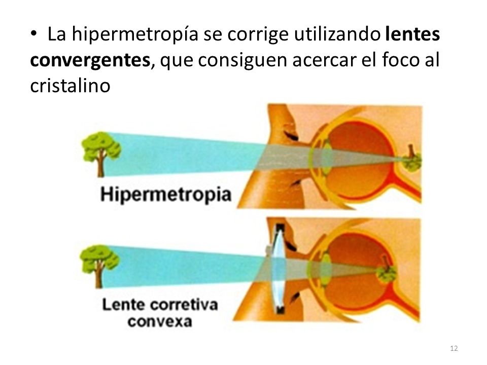 La hipermetropía se corrige utilizando lentes convergentes, que consiguen acercar el foco al cristalino