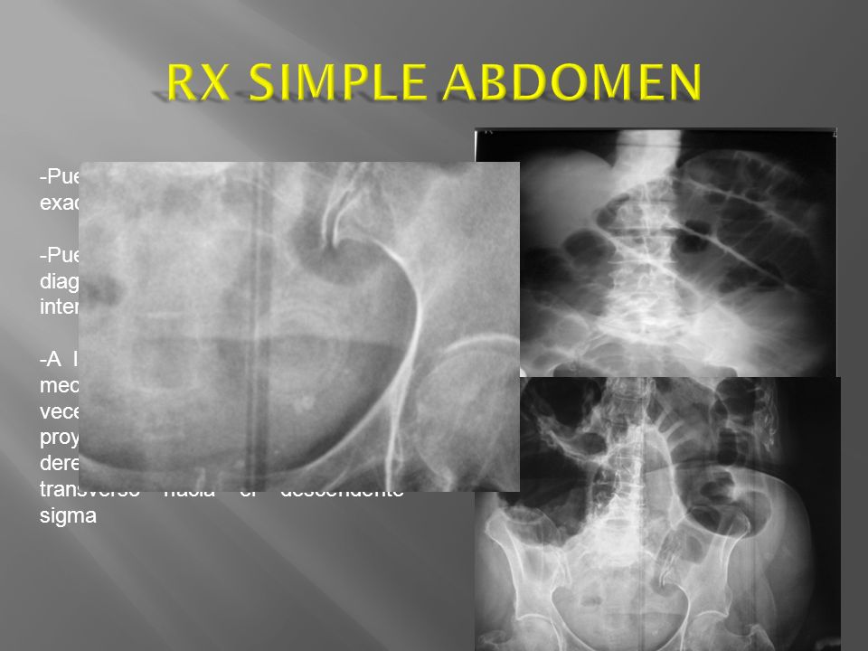 RX SIMPLE ABDOMEN -Puede ser complicado determinar exactamente el nivel de obstrucción.