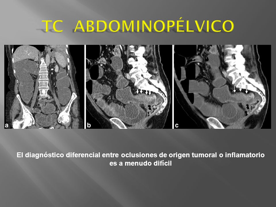 TC ABDOMINOPÉLVICO El diagnóstico diferencial entre oclusiones de origen tumoral o inflamatorio.
