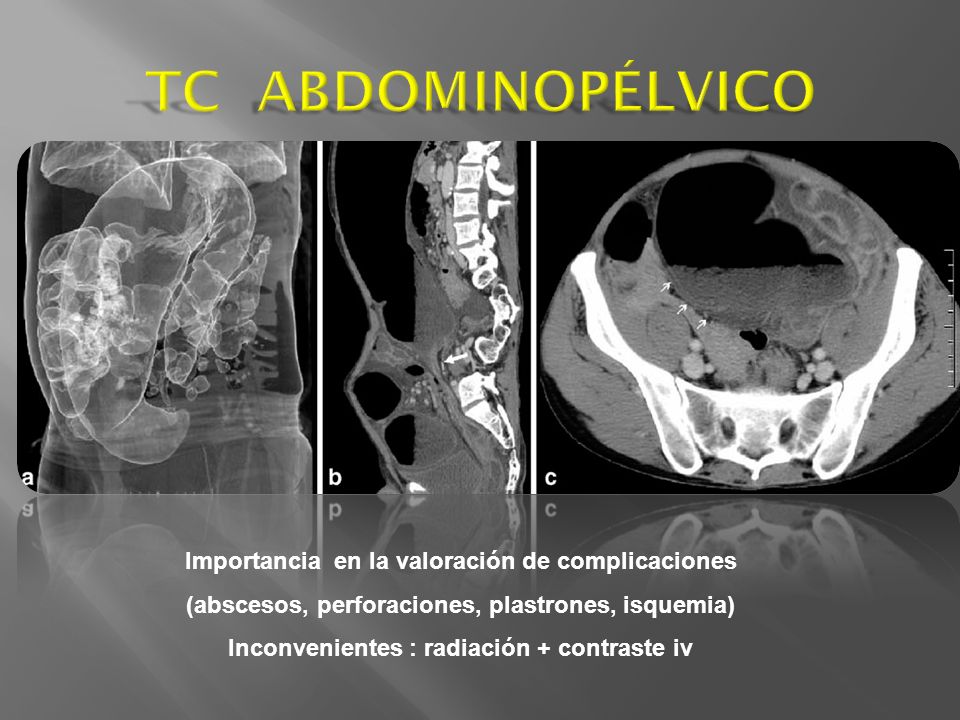 TC ABDOMINOPÉLVICO Importancia en la valoración de complicaciones
