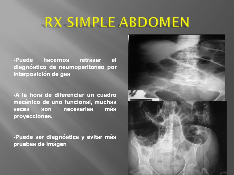 RX SIMPLE ABDOMEN -Puede hacernos retrasar el diagnóstico de neumoperitoneo por interposición de gas.